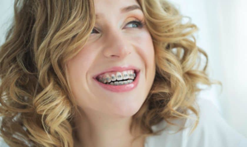 Know About Types Of Braces In Detail
