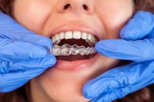 invisalign aligners setup during alignment treatment