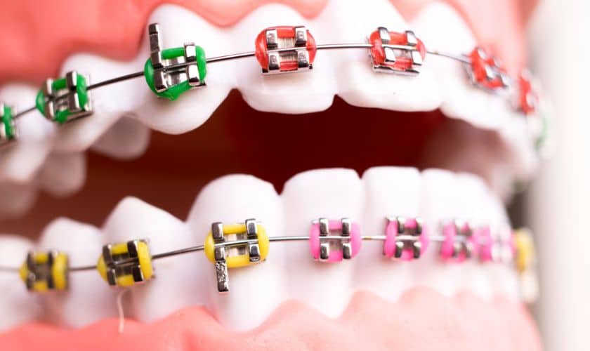 Celebrating Valentines Day with Braces Colors