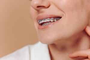 women wearing metal braces