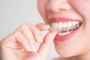 Woman inserting a clear Invisalign aligner tray over her upper teeth.